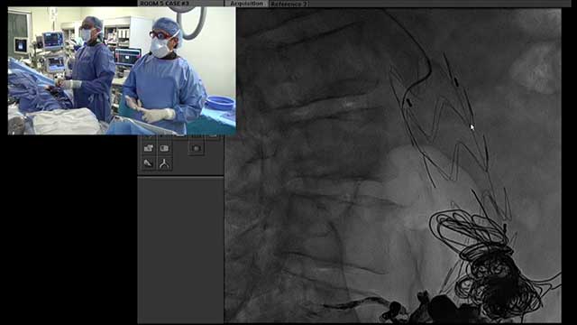 Transradial Endoleak Angiography post EVAR for Aortic Aneurysm