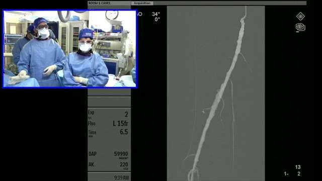 Transradial Access for Above the Knee (SFA) Angioplasty and Stenting