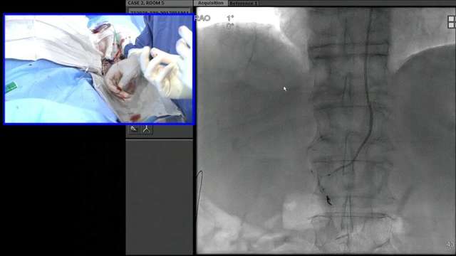 Transradial Embolization of the Right Gastric Artery Prior to Y90 Radioembolization