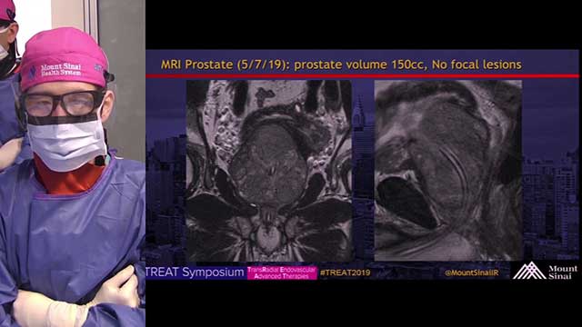 Transradial Balloon Occlusion Prostate Artery Embolization (PAE) for BPH