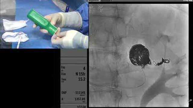 Transradial Coil Embolization of a Renal Artery Aneurysm