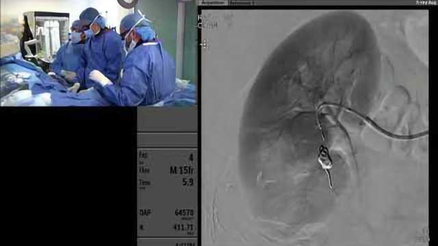 Transradial Coil and Plug Embolization of a Renal Arterial Venous Fistula