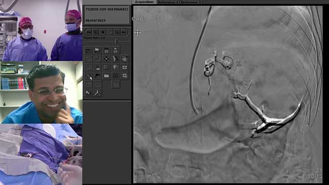 Transradial Embolization of a Giant Renal Oncytoma with n-BCA and Onyx Liquid Embolic