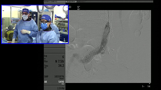 Transradial Evaluation of Type 1 and 3 Endoleaks post EVAR