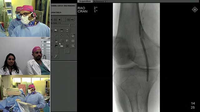 Transradial Infrapopliteal Atherectomy, Angioplasty and Stenting for Critical Limb Ischemia