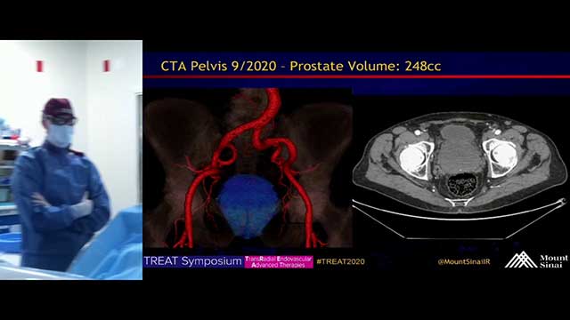 Transradial Prostate Artery Embolization for Benign Prostatic Hyperplasia (BPH)