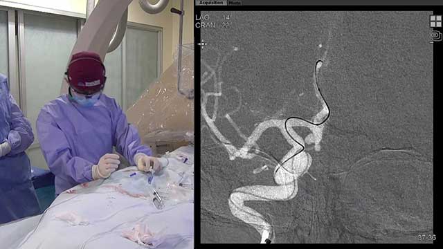 Transradial Stent-Assist Coil Embolization of an Anterior Communicating Artery (ACOM) Brain Aneurysm