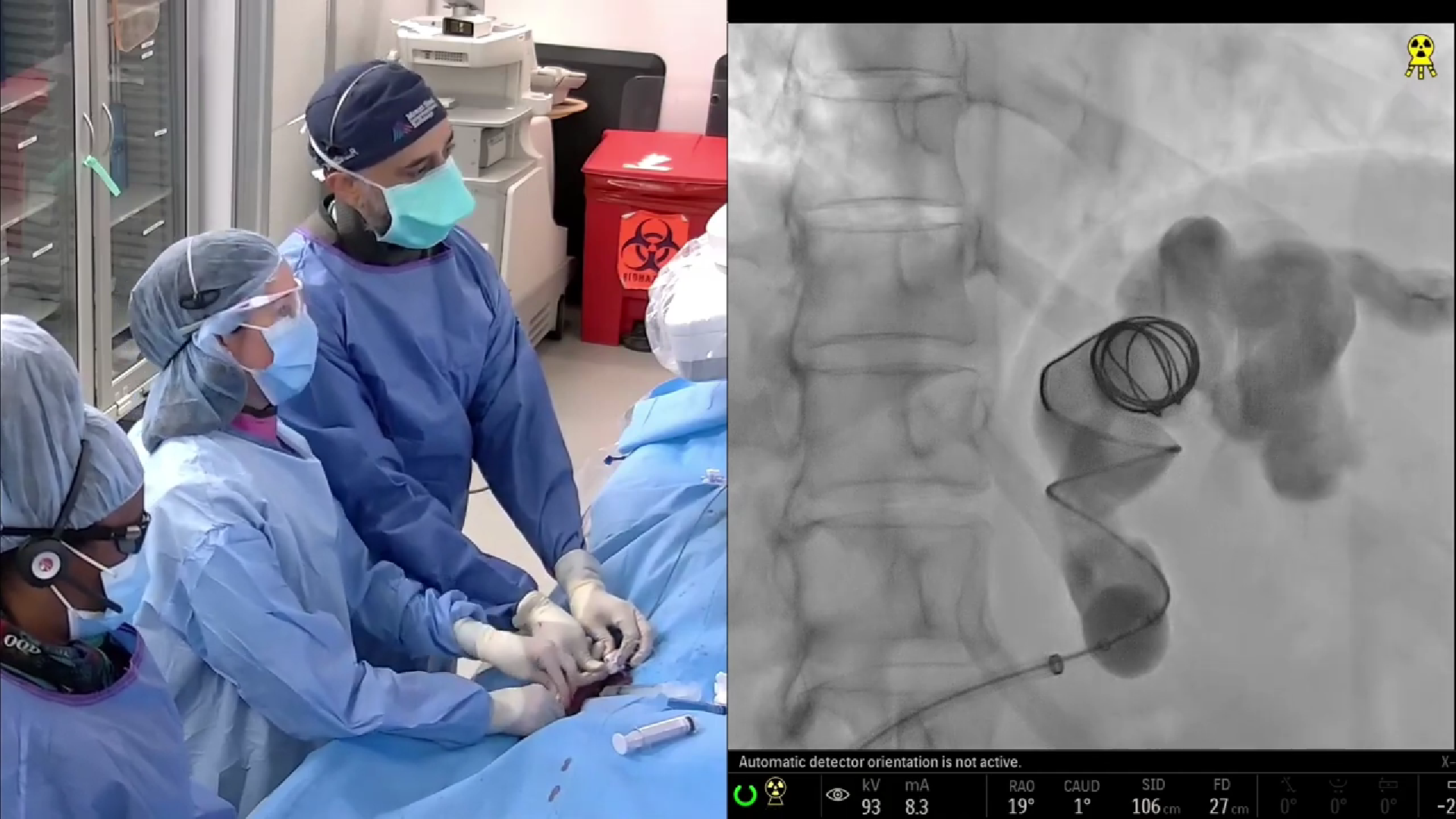 Variceal Embolization
