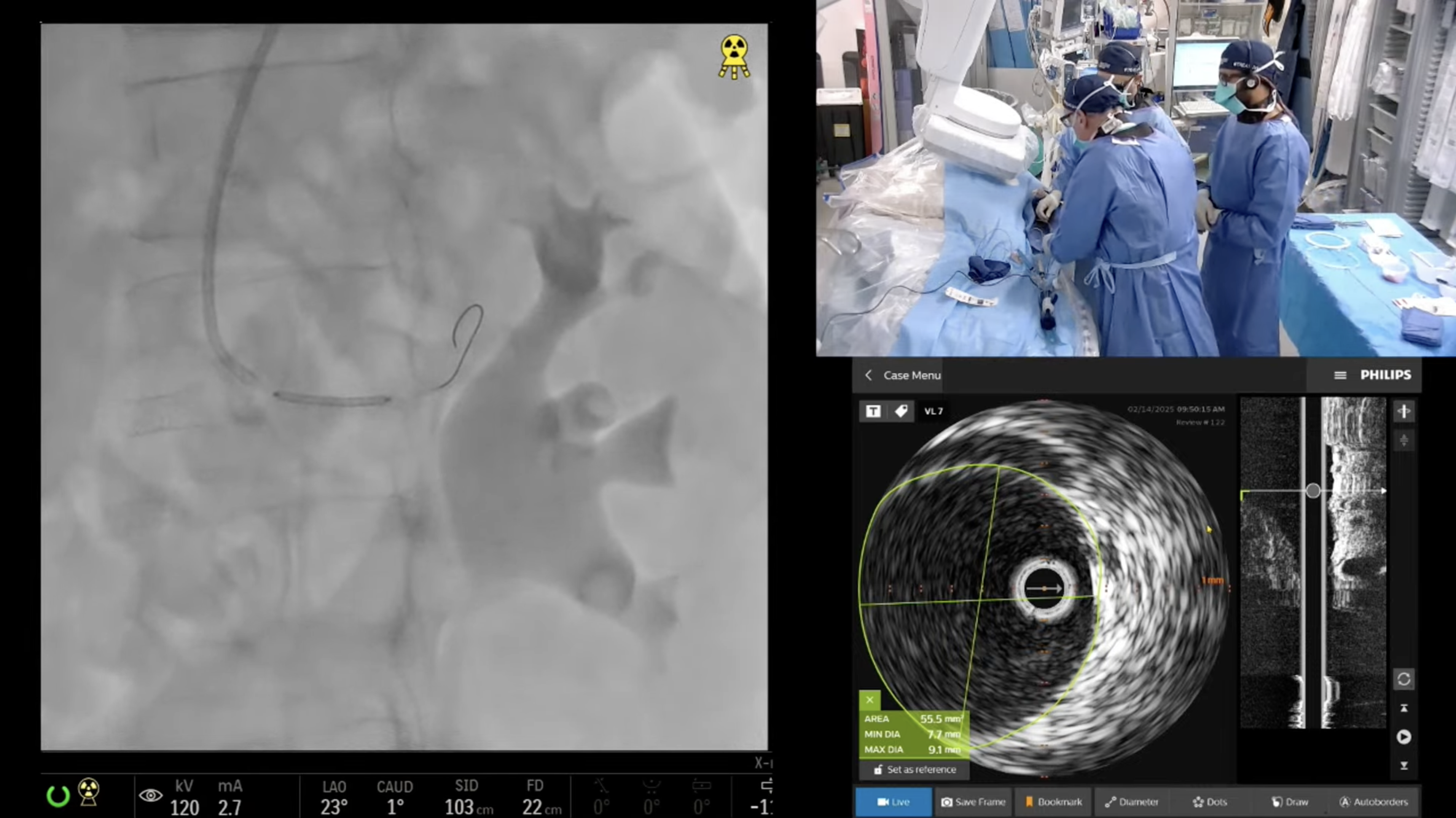 Transradial Stenting for Severe Renal Artery Stenosis