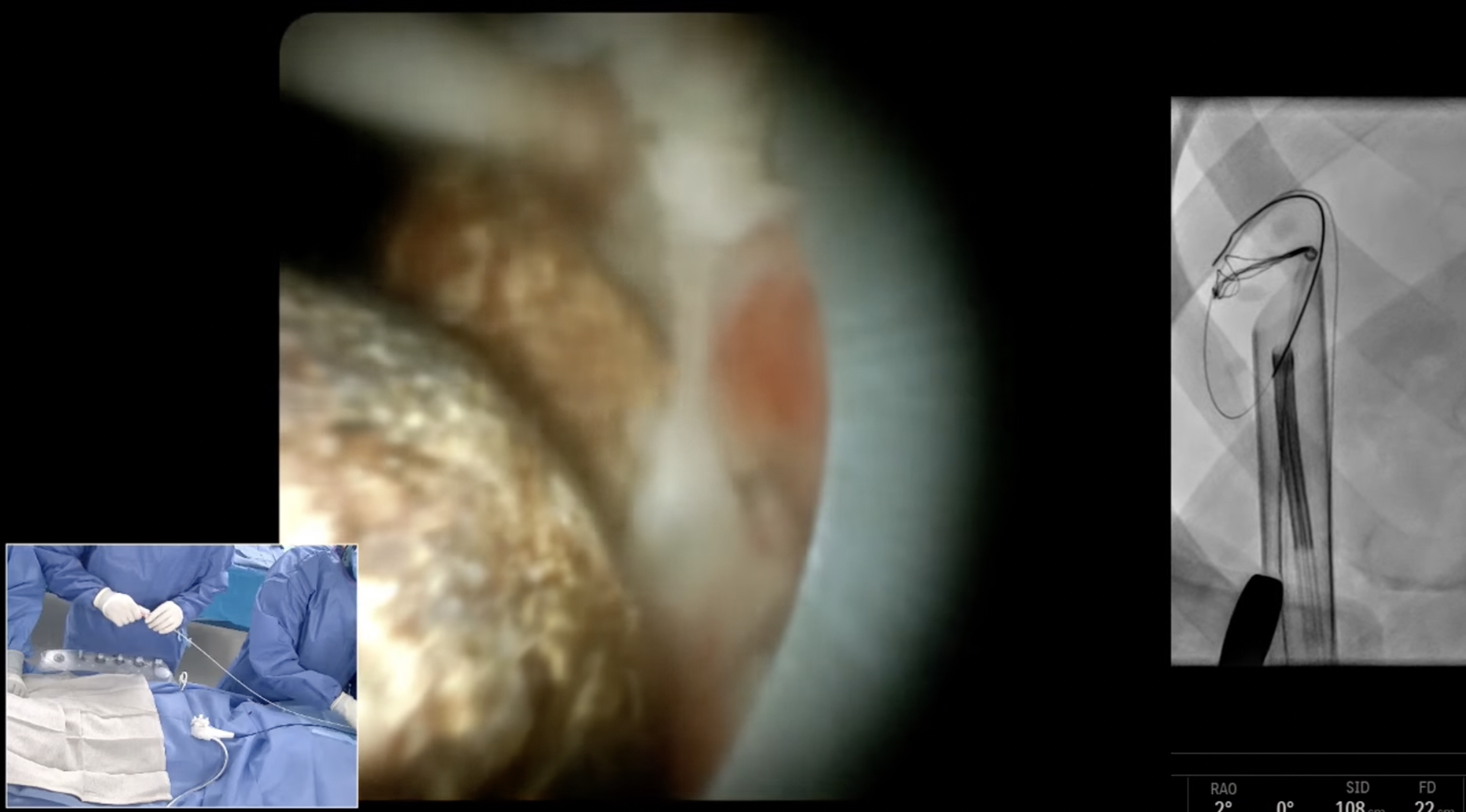 Dropped Gallstone Retrieval