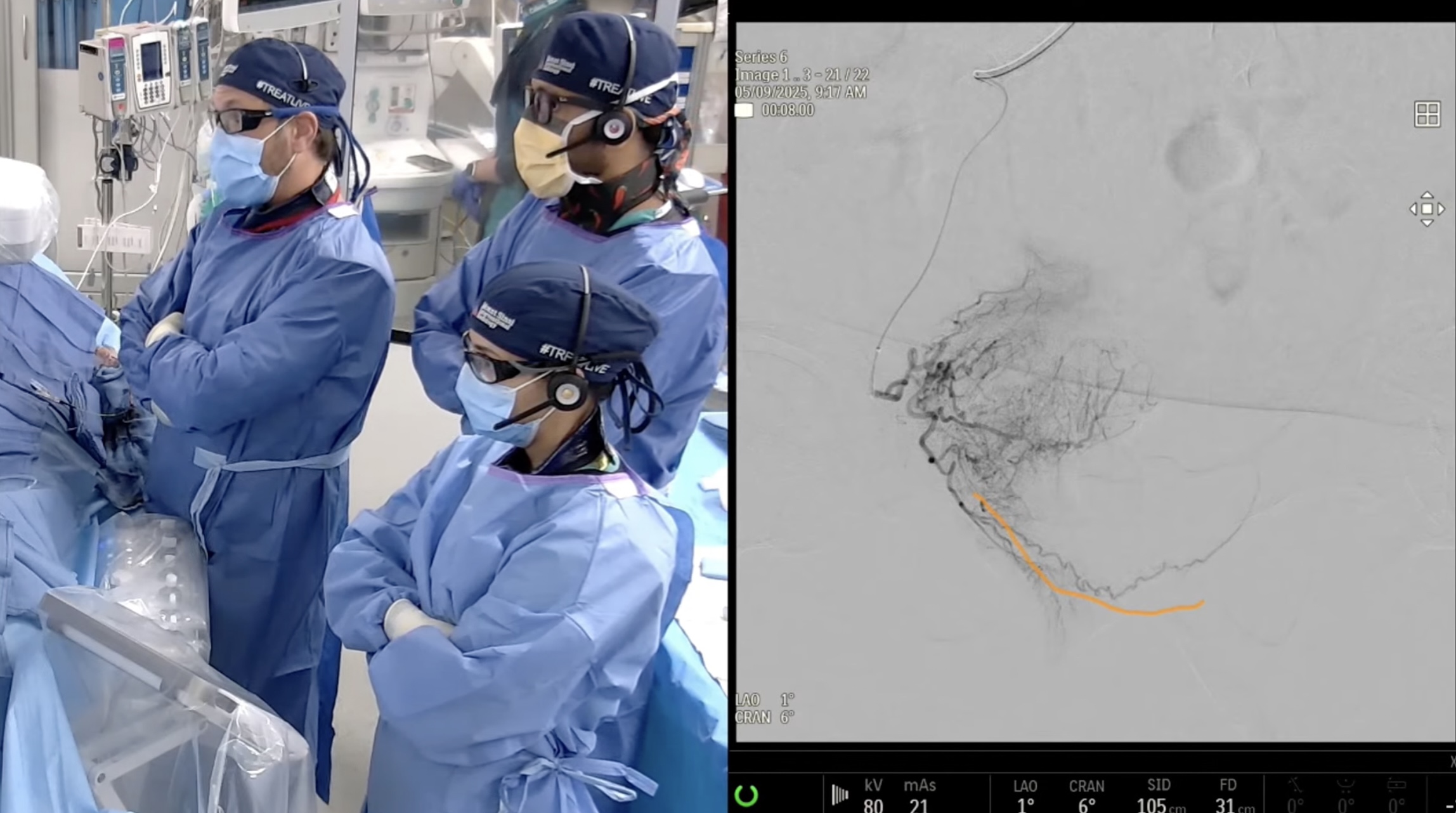 PAE using n-BCA liquid embolic