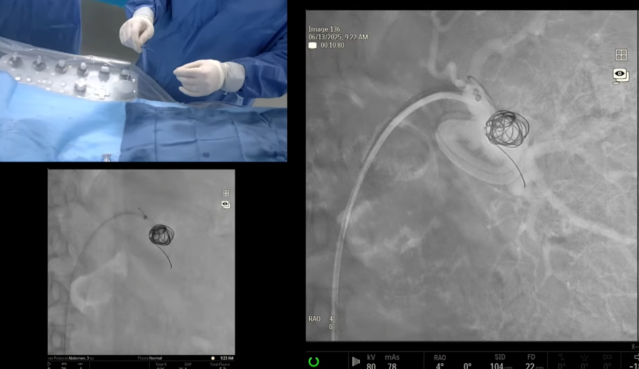 Splenic Artery Aneurysm Coil Embolization via a Femoral Approach