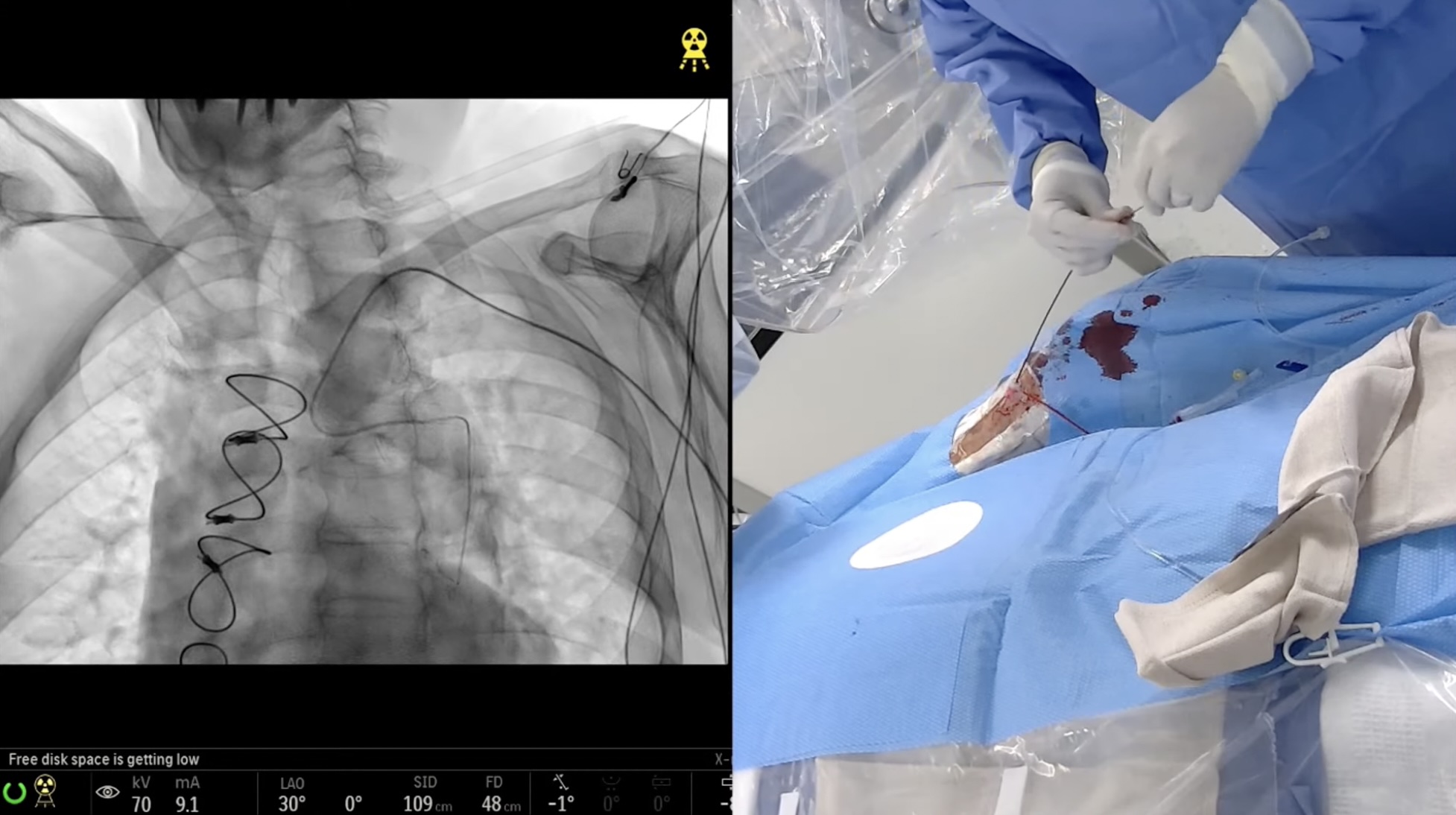 Hypogastric Artery Embolization via a Radial Approach