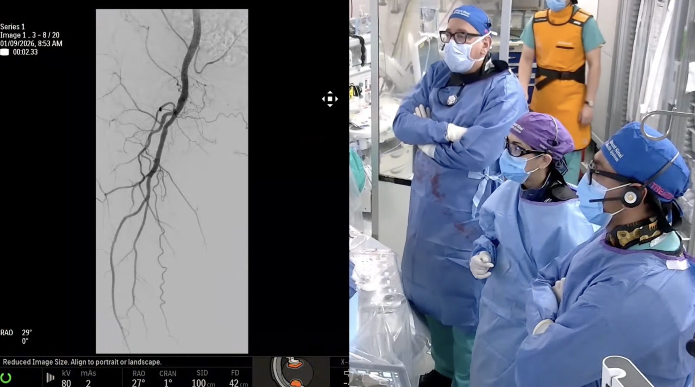 Lower Extremity Revascularization