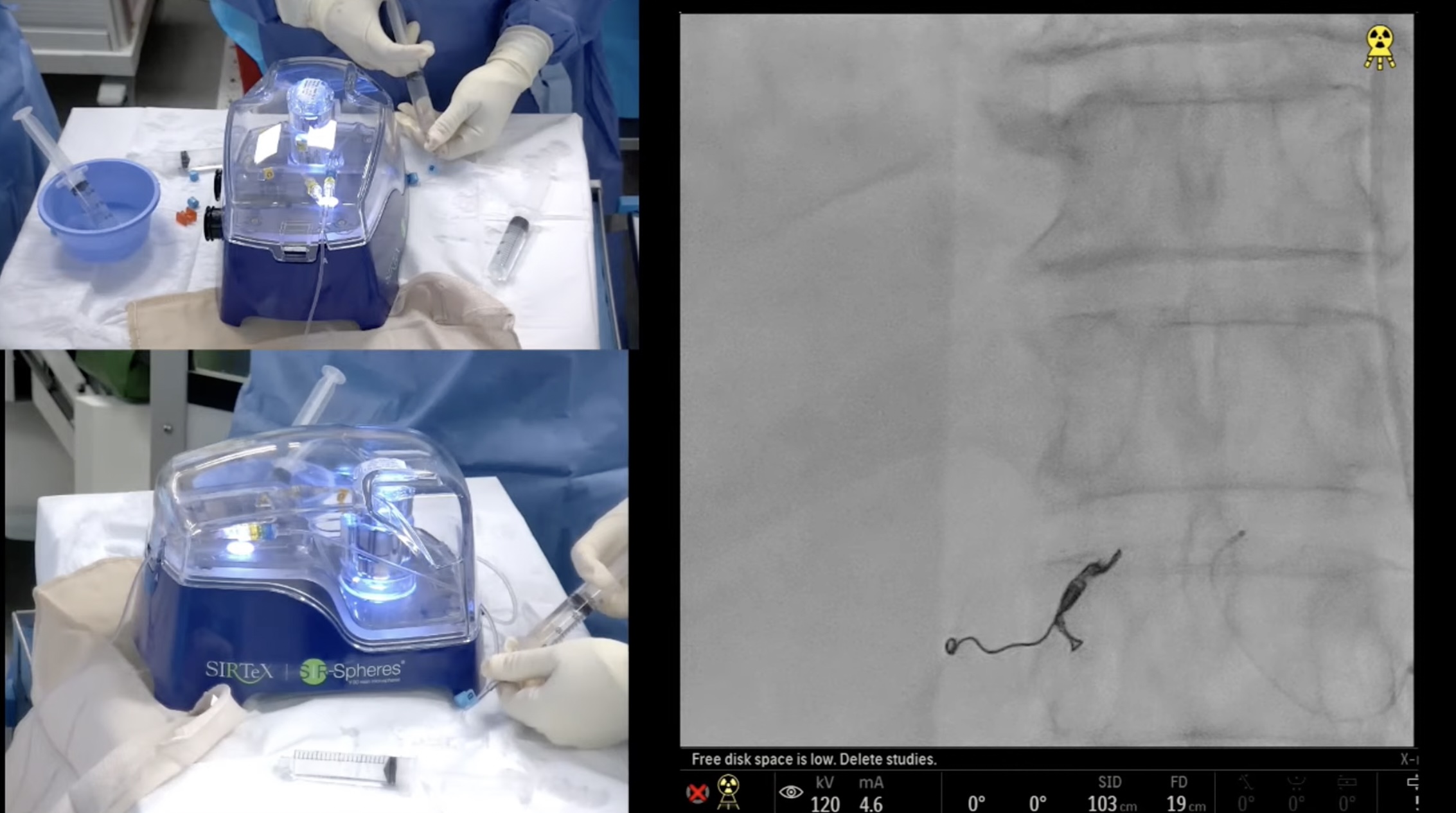 Yttrium – 90 Radioembolization of Hepatic Metastases