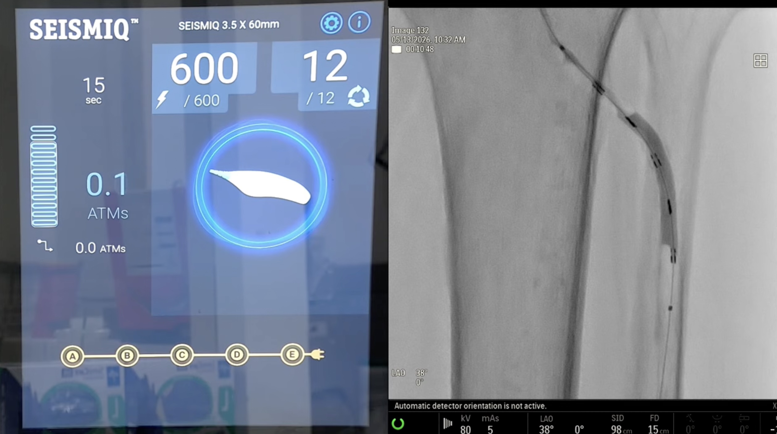 Lower Extremity Revascularization for CLTI